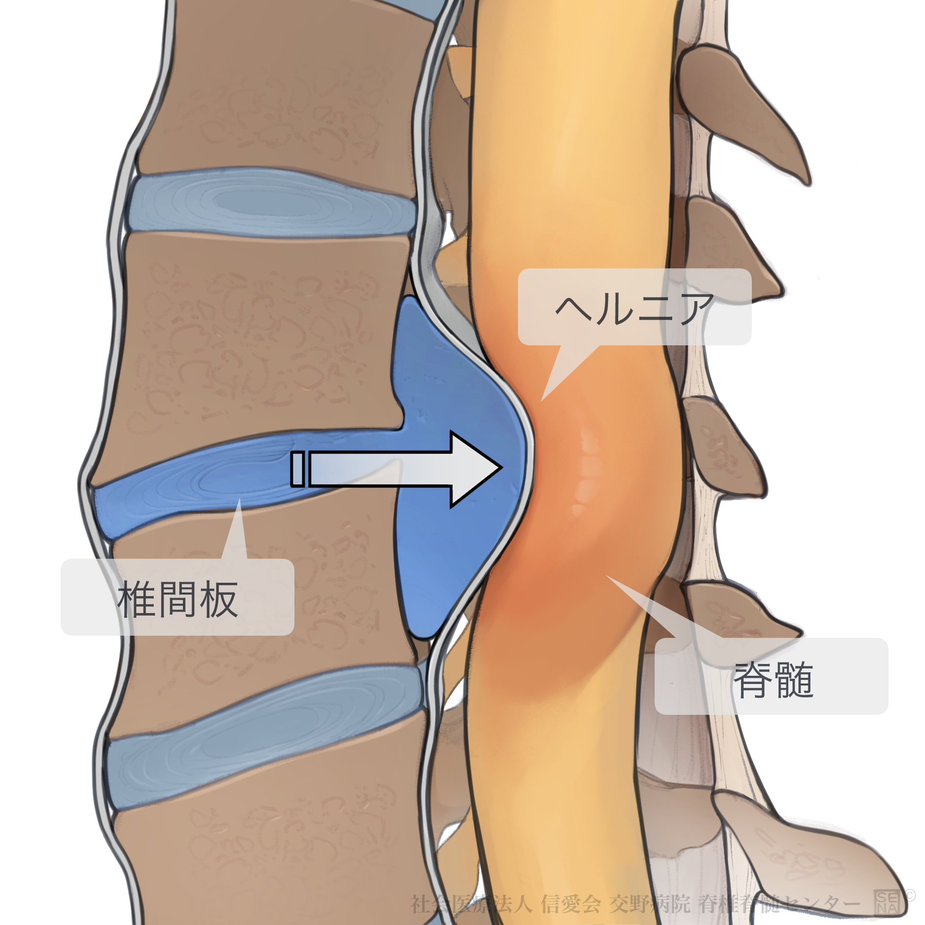 頚椎椎間板ヘルニア