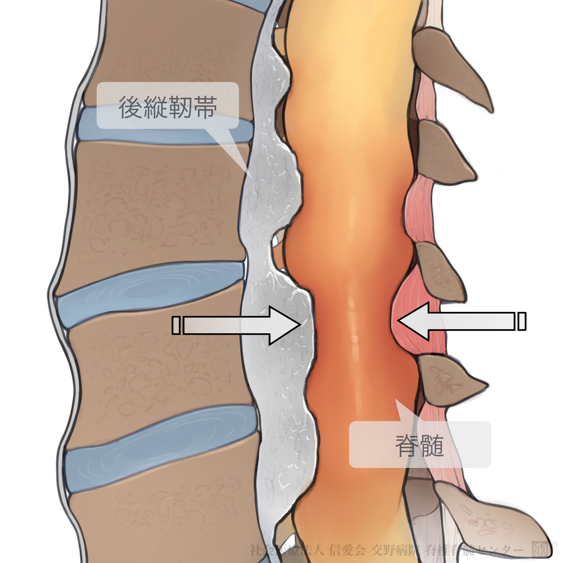 後縦靭帯骨化症