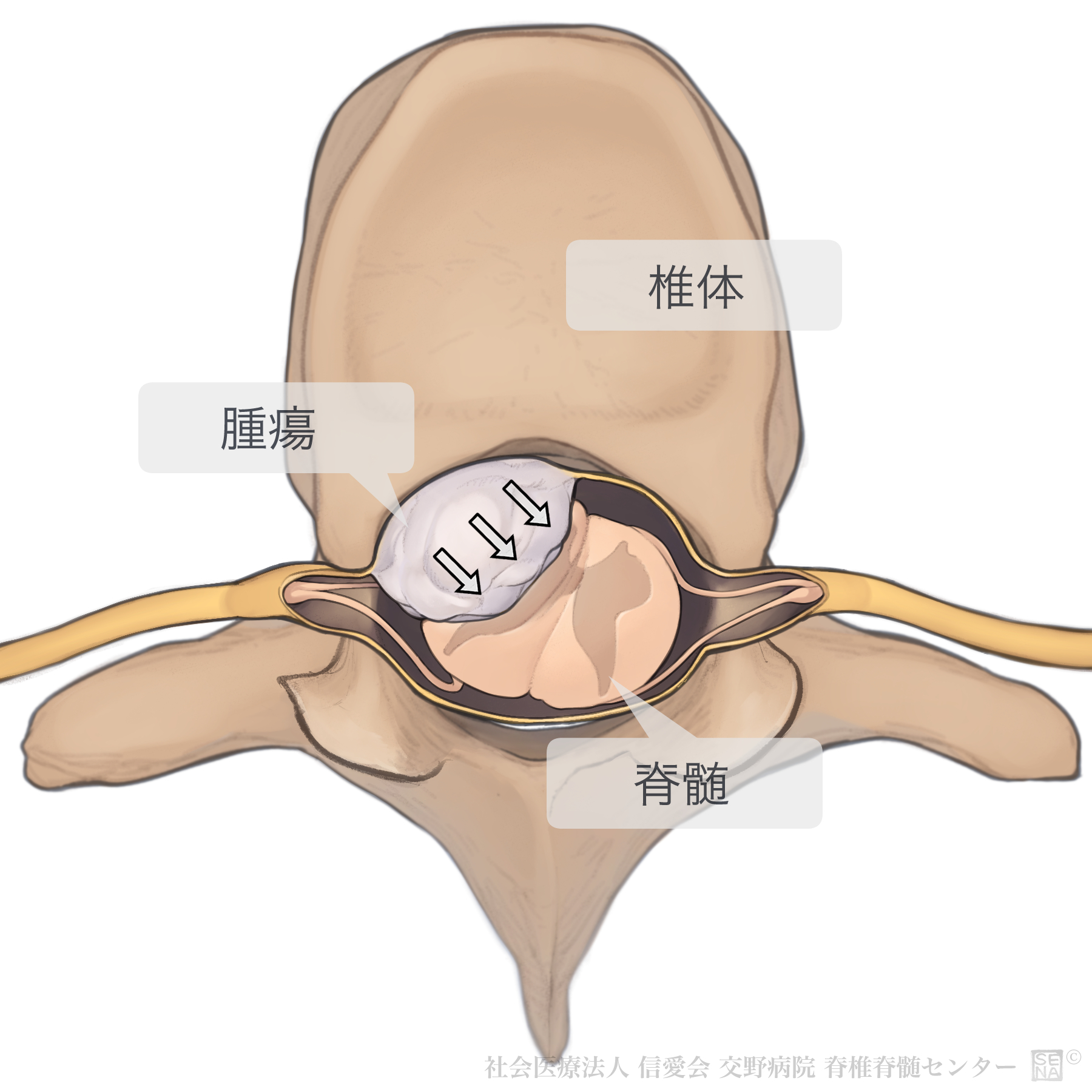 硬膜内髄外腫瘍