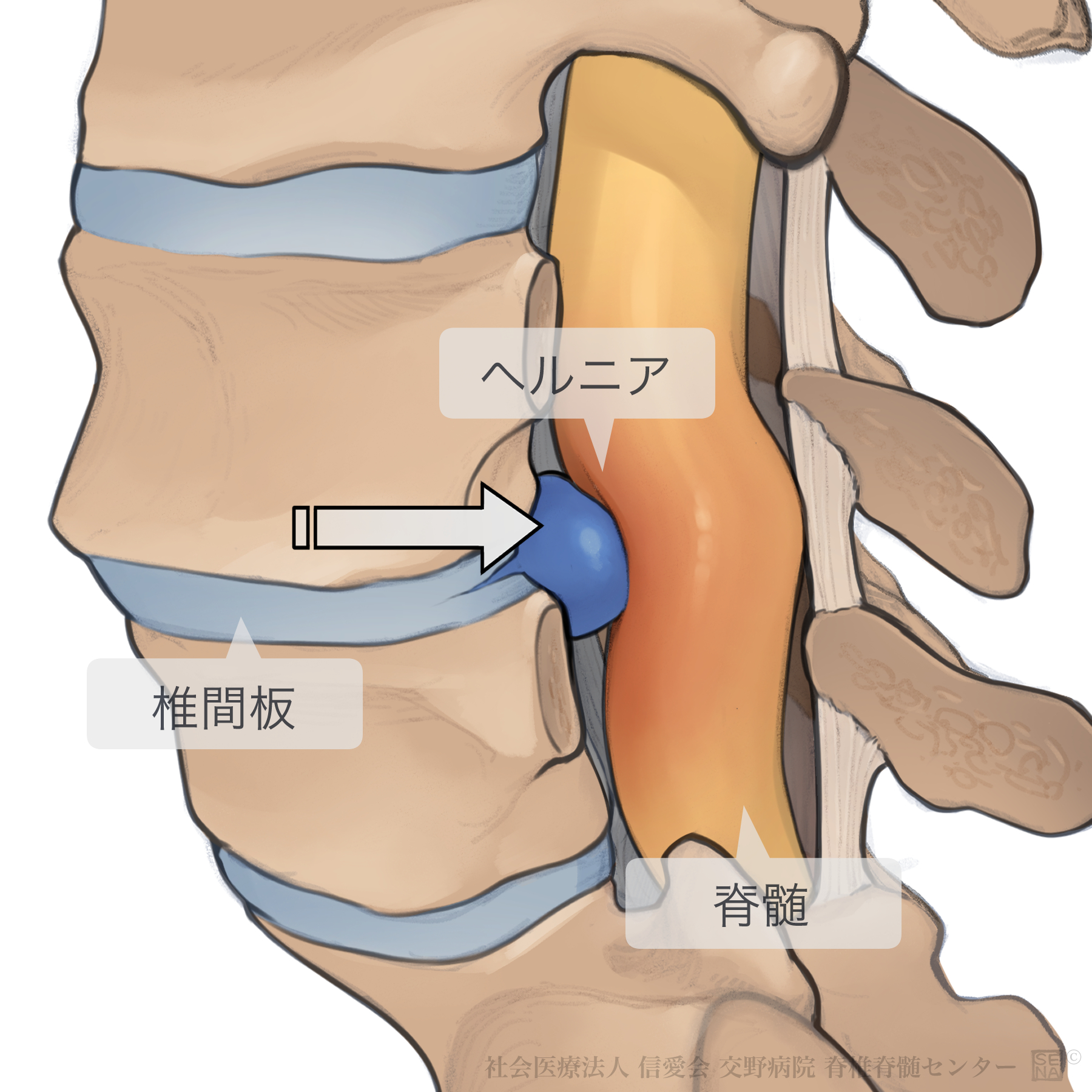 腰部椎間板ヘルニア