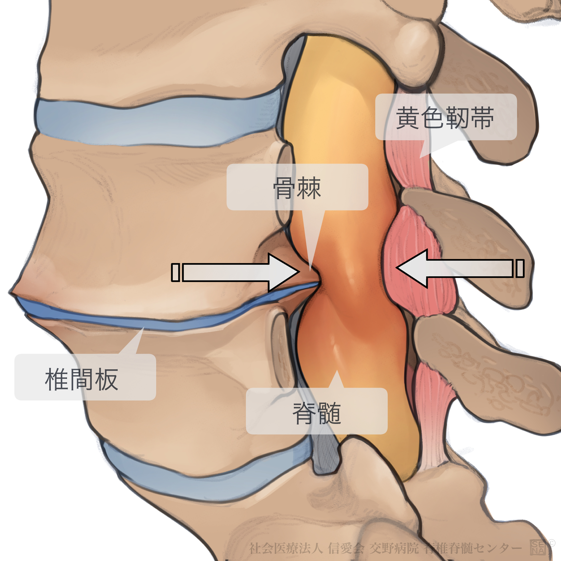 腰部脊柱管狭窄症