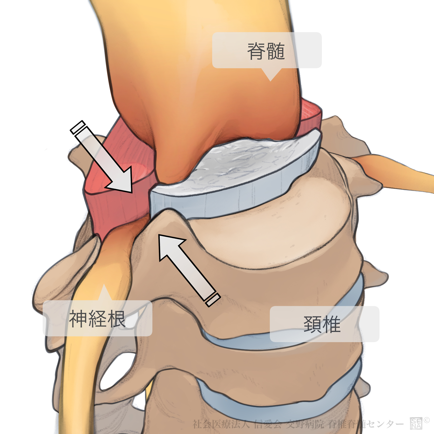 後縦靭帯骨化症